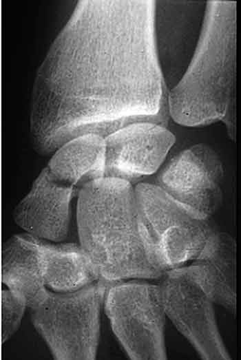 Fracture du scaphoïde : Pourquoi je crois qu'il faut souvent les opérer ?