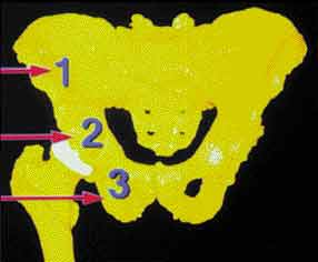 Reconstruction du bassin par autogreffe segmentaire du fémur homolatéral
