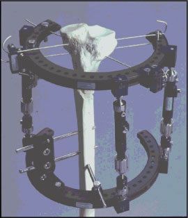 Utilisation du fixateur hybride de Sheffield en traumatologie