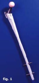 Technique d'implantation de la tige fémorale modulaire verrouillée de reconstruction Reef.