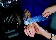 Examen clinique des traumatismes ligamentaires du poignet