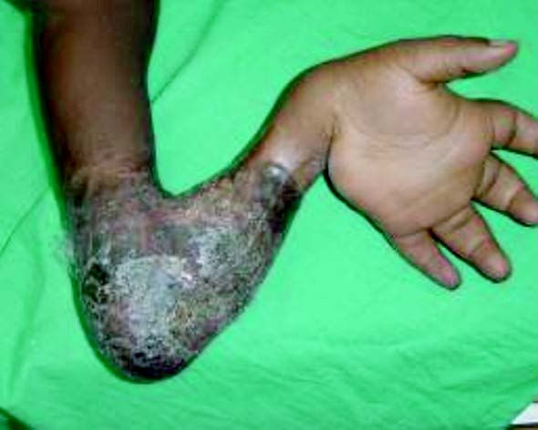 Chirurgie réparatrice en situation précaire -  Couverture du coude