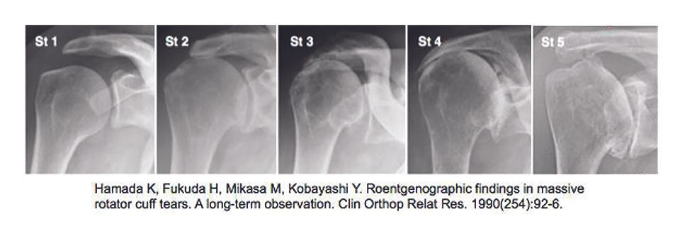 La réparation supérieure capsulaire : technique arthroscopique
