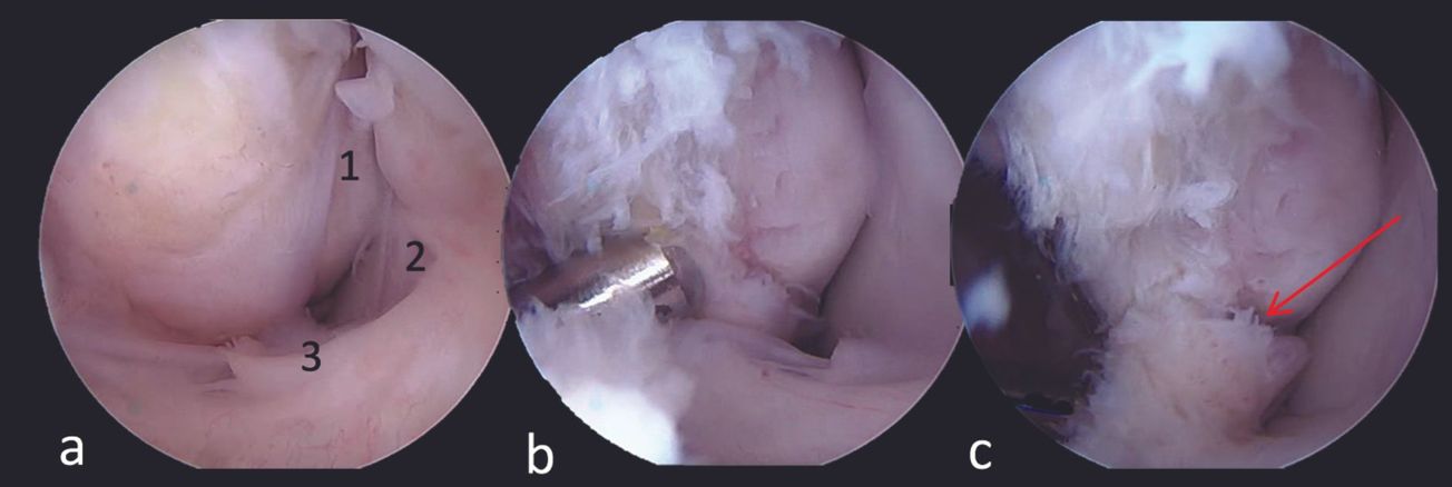 Prise en charge arthroscopique des instabilités latérales de la cheville