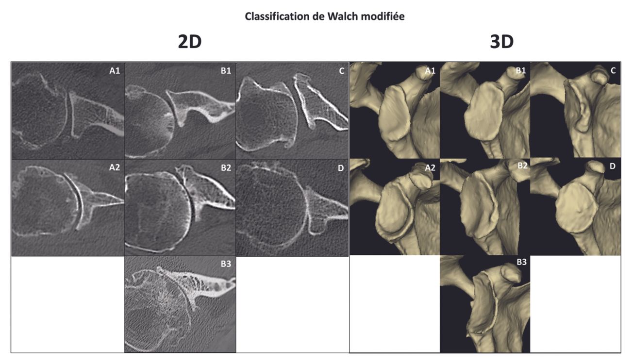 L’utilisation du Machine Learning peut-elle aider à la Classification Automatisée des Omarthroses Centrées ?