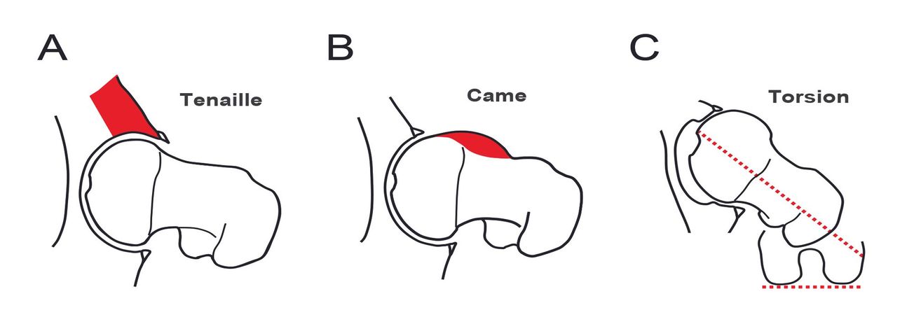 Conflit fémoro-acétabulaire : quelle place pour la chirurgie à ciel ouvert ?