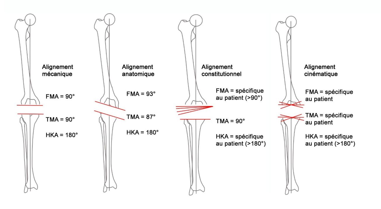 Le « concept de phénotype fonctionnel du genou »  et son impact sur la controverse autour  du choix de l’alignement frontal optimal  dans les PTG