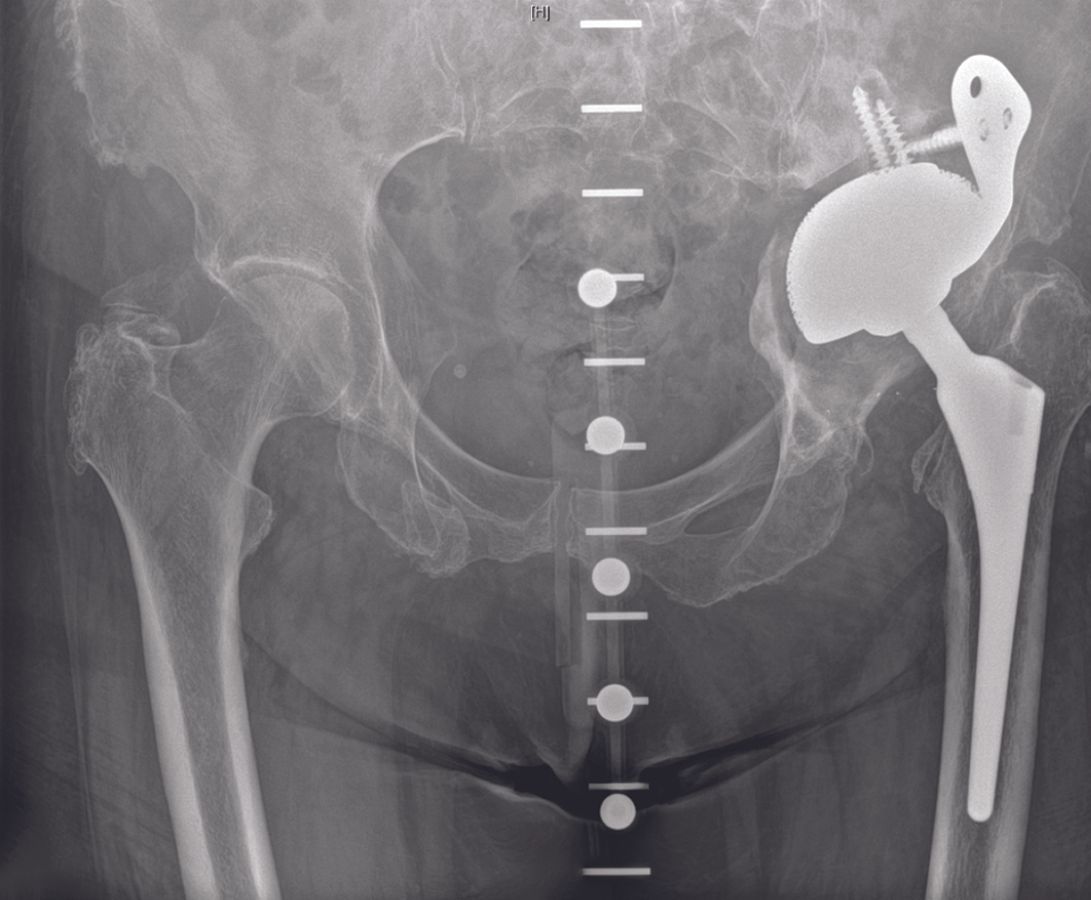 Reconstruction par cage acétabulaire dans les pertes de substance osseuse acétabulaire sévères et les discontinuités pelviennes