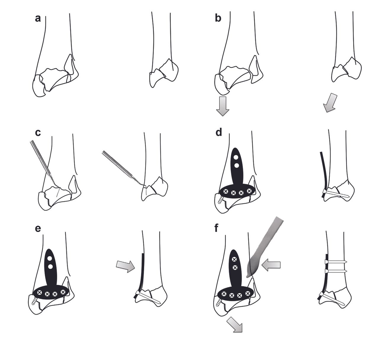 Chirurgie mini-invasive des fractures du radius distal