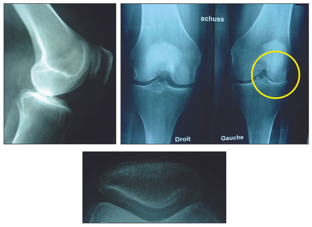 Prothèses unicompartimentales latérales : le respect des indications et  d’une technique rigoureuse sont les garants d’excellents résultats à long terme