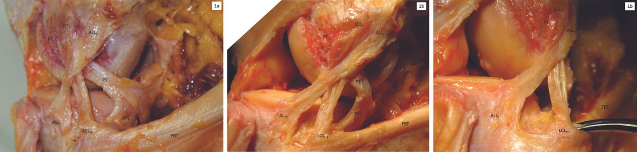 Le ligament antérolatéral du genou : qu’est-ce que l’on sait sur ses propriétés  anatomiques, histologiques et biomécaniques ?