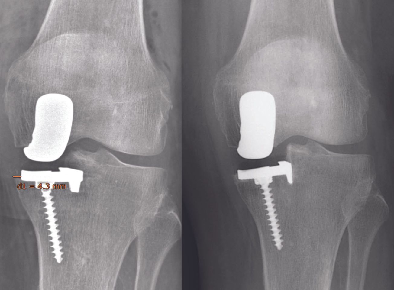 Critères radiologiques d’une prothèse unicompartimentale réussie