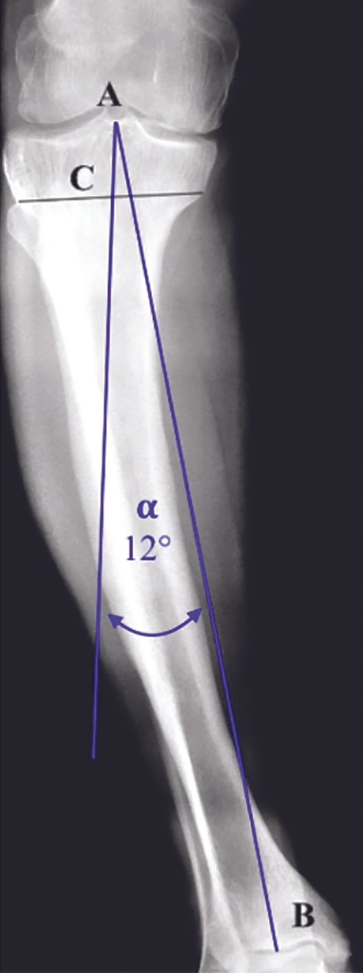 Choix de la contrainte dans les grandes déformations en varus