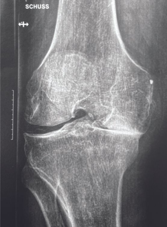 Prothèse de genou ATTUNE naviguée : resultats à moyen terme à propos de 1000 cas