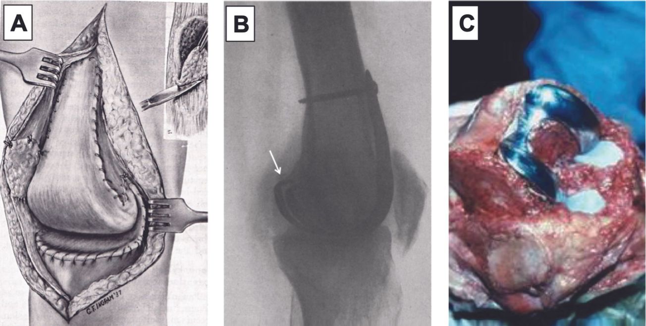 L’alignement dans les Prothèses Totales du Genou