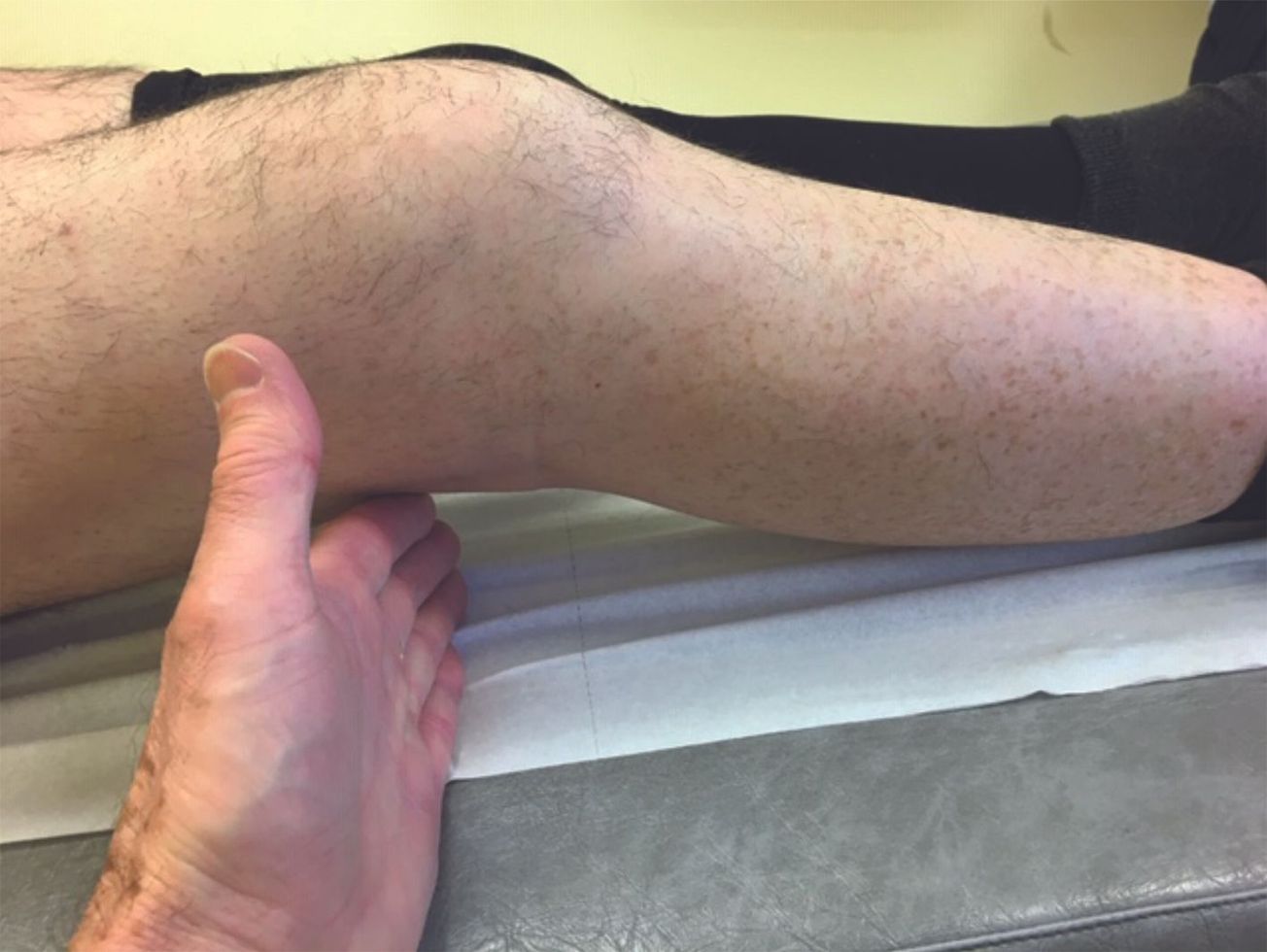 La gestion du flexum au cours des prothèses totales de genou (PTG)