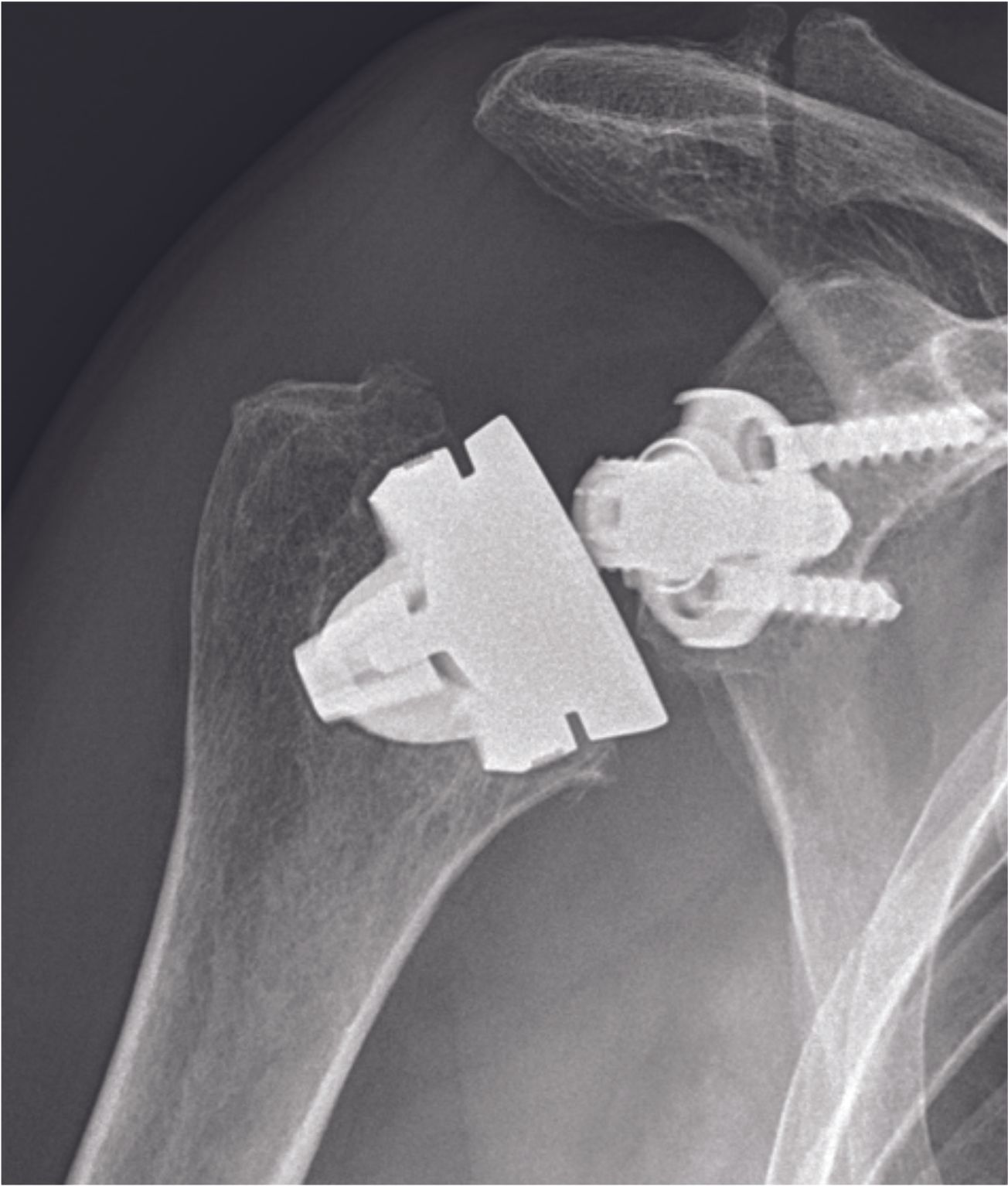 Réussir une prothèse inversée d’épaule  sans tige, focus sur l’humérus : analyse rétrospective d’une série de 86 prothèses SMR, avec min. 2 ans de recul