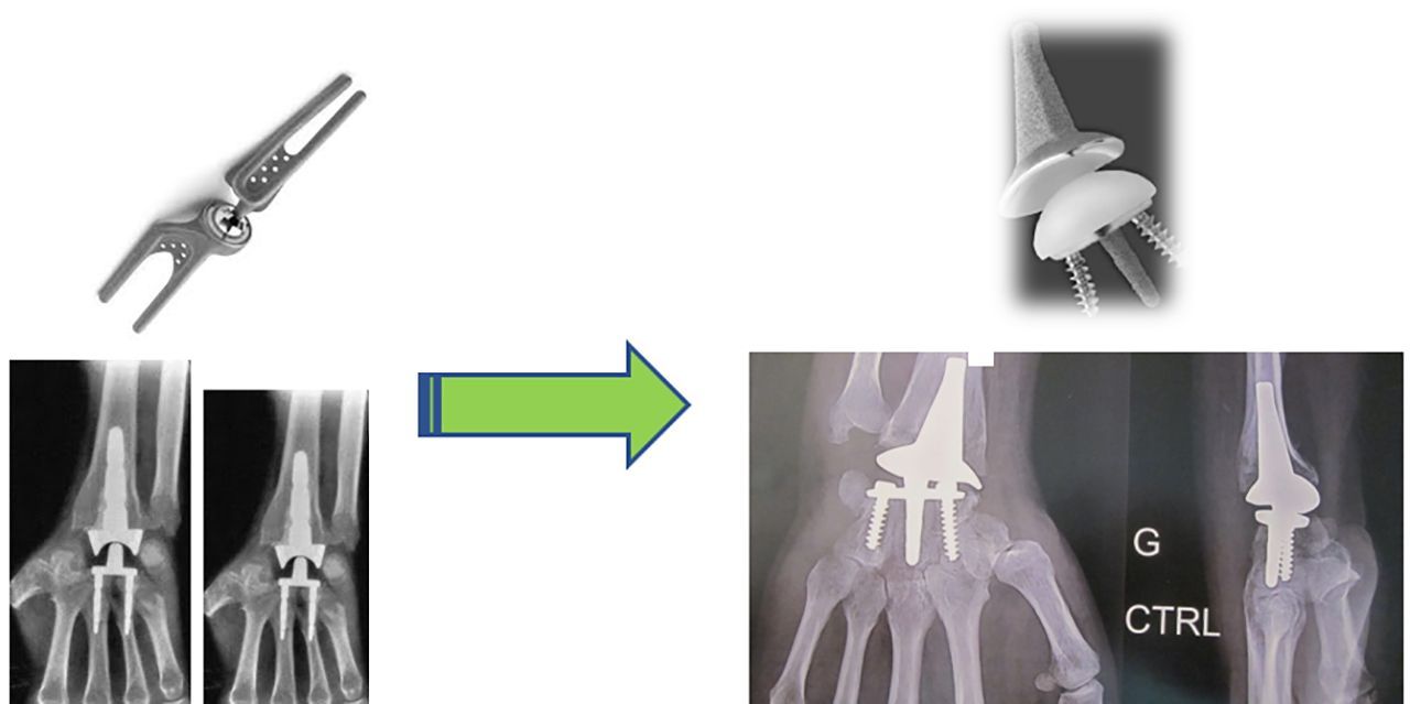 Que retenir après une décennie de prothèses totales de poignet ?