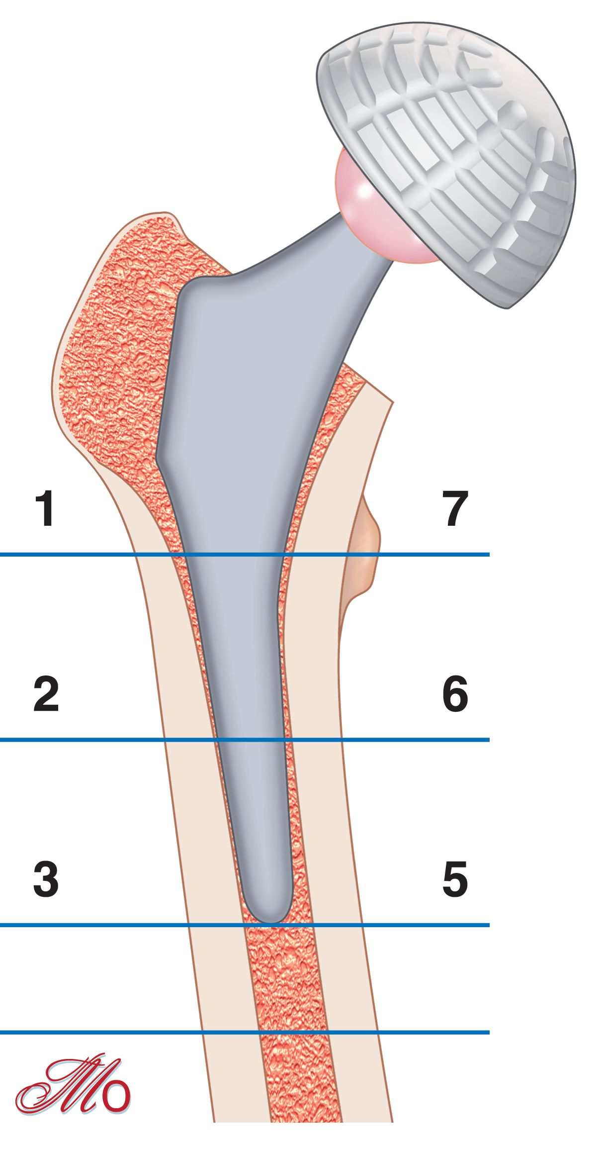 Spécificités de l’arthroplastie totale de la hanche chez les patients avec un déficit de masse osseuse