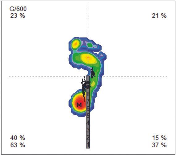 Pourquoi la ténolyse du tendon du Flexor Hallucis Longus associée à la ligamentoplastie du croisé antérieur peut améliorer l’équilibre dynamique et le bien-être du patient