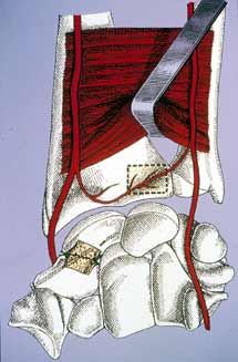 Traitement des pseudarthroses du scaphoïde par un greffon osseux vascularisé prélevé sur la face antérieure du radius