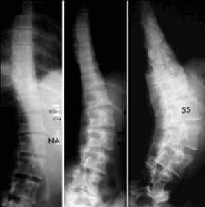 Traitement orthopédique précoce par orthèse élastique des scolioses lombaires et thoraco-lombaires