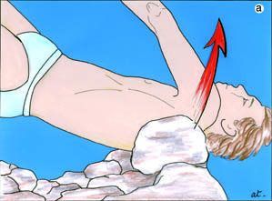 Instabilité antérieure chronique de l'épaule