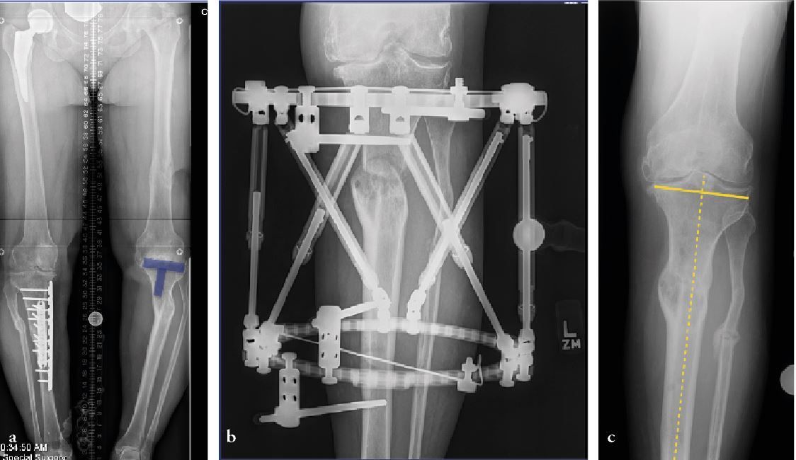 Les défis posés par l’arthroplastie totale du genou dans l’arthrose post-traumatique : une approche sous forme de livre de recettes