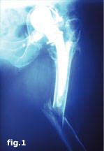 Les reprises de hanche : Réflexions stratégiques pour la reprise fémorale