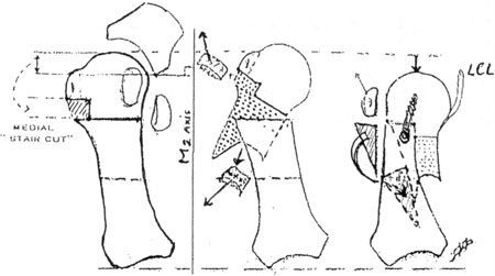 Chirurgie du pied : innovations et banque de tissu