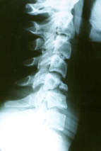 Prise en charge chirurgicale des fractures Tear- Drop du rachis cervical inférieur