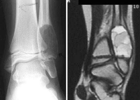 L'implantation de particules osseuses déminéralisées dans le kyste osseux anévrysmal : un nouveau concept biologique