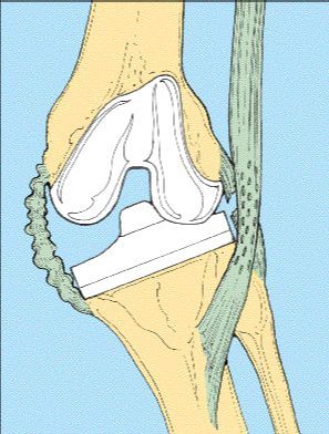 Plastie ligamentaire interne dans l'arthroplastie prothétique du genou