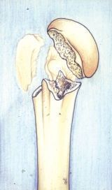 Ostéosynthèse des fractures de l'extrémité supérieure de l'humérus par implant Bilboquet