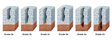 Evaluation arthroscopique des lésions chondrales du genou