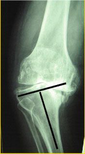 Place des différents types d'arthroplastie dans le traitement de l'arthrose du genou