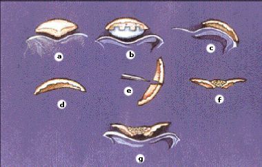 L'ostéotomie patellaire en "ailes de Goéland" dans l'arthroplastie prothétique du genou.