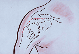 Le lambeau de deltoïde : technique opératoire et indication.