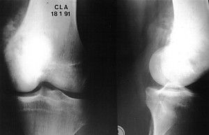 Allogreffe cartilagineuse massive d'un genou en totalité selon la technique de D. Poitout