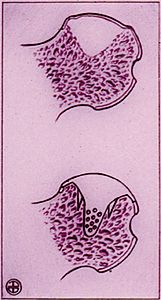 Implant de resurfaçage partiel MS dans le traitement de l'ostéonecrose aseptique de la tête femorale.Technique originale, à propos de 35 cas aseptique de la tête fémorale