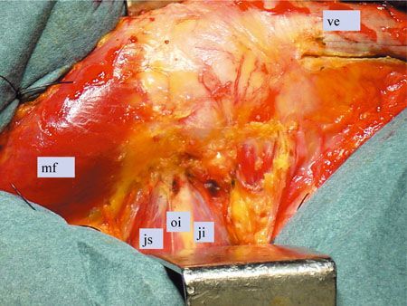 Abord externe de la hanche avec trochantérotomie