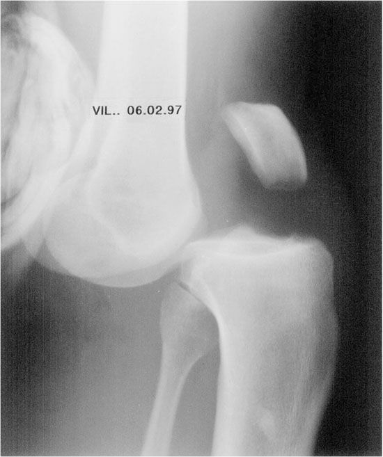 Stratégie diagnostique dans les pentades et les luxations du genou