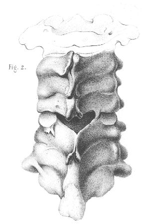 Extrait de l'atlas du traité des fractures et des luxations - Planche XVII : Luxation des Vertèbres cervicales