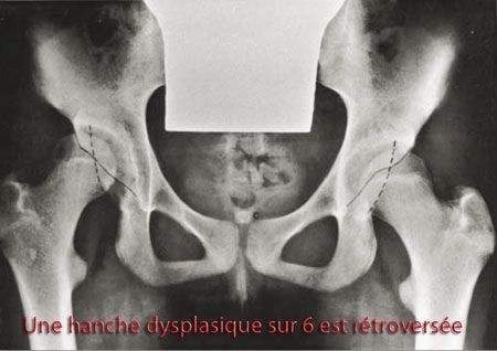 Place de l'ostéotomie périacétabulaire dans le traitement des dysplasies cotyloïdiennes