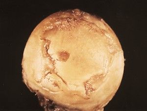 Ostéonécrose de la tête fémorale avant le stade de prothèse