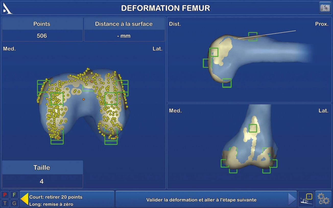 Apport de la Navigation pour la conception d’une Prothèse Totale de Genou