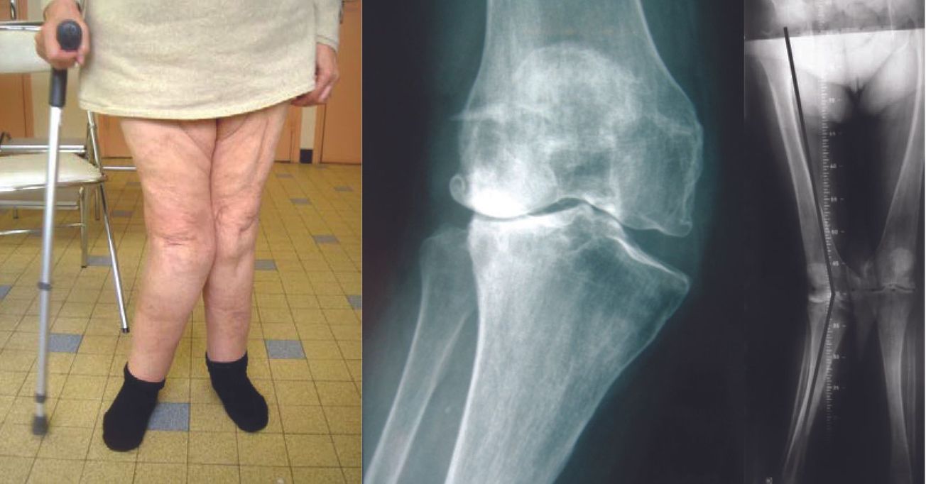 Indications actuelles des prothèses charnières