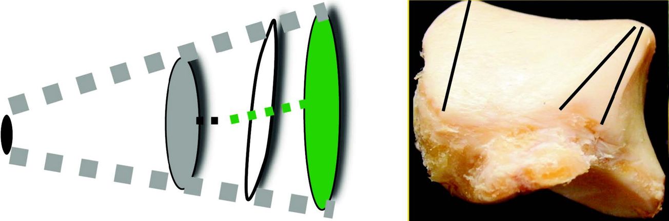 L’instabilité chronique de cheville : démembrement et propositions thérapeutiques