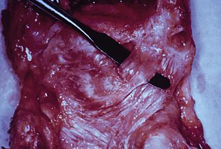 L'instabilité du carpe