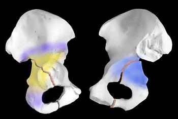 Réduction et ostéosynthèse des fractures du cotyle par voie d'abord de Köcher-Langenbeck. Truc et astuces